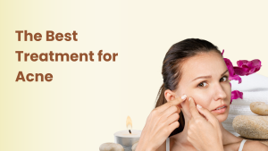 beige aesthetic beauty care the best treatment for acne (blog banner)